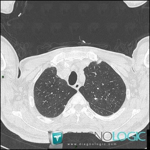 Silicosis, Pulmonary parenchyma, CT