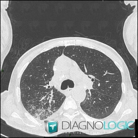 Silicosis, Pulmonary parenchyma, CT