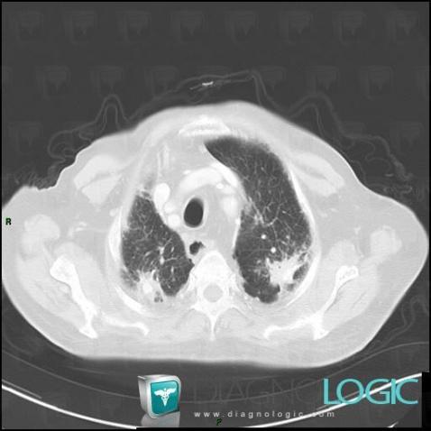 Silicosis, Pulmonary parenchyma, CT