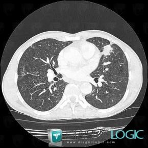 Silicosis, Pulmonary parenchyma, CT