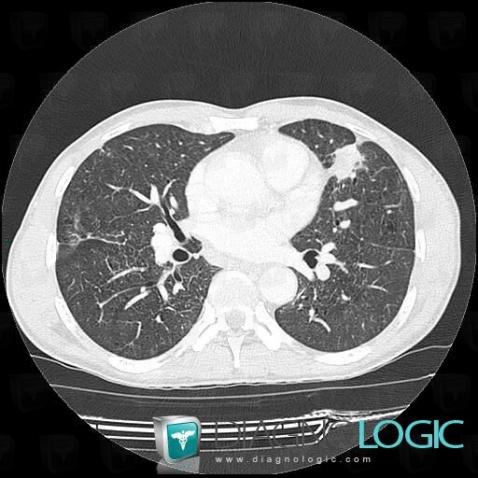 Silicosis, Pulmonary parenchyma, CT