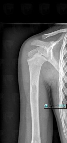 Simple bone cyst, Humerus - Mid part, X rays