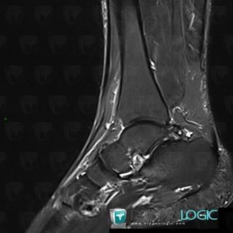 Sinus tarsi syndrome, Other ligaments - Ankle, MRI