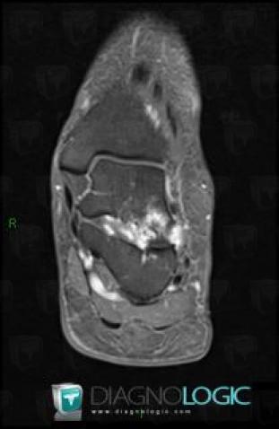 Sinus tarsi syndrome, Subtalar joints, Other ligaments - Ankle, MRI