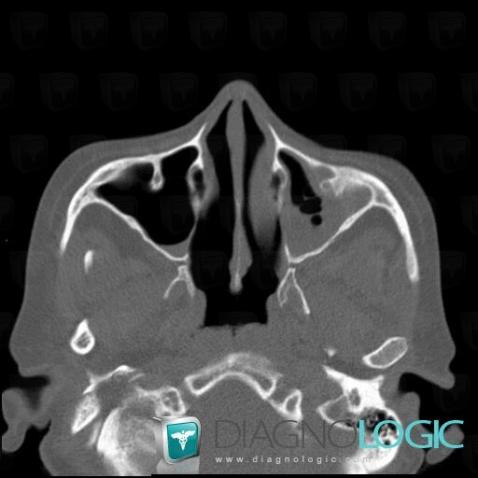 Radiology case : Sinusitis (CT) - Diagnologic