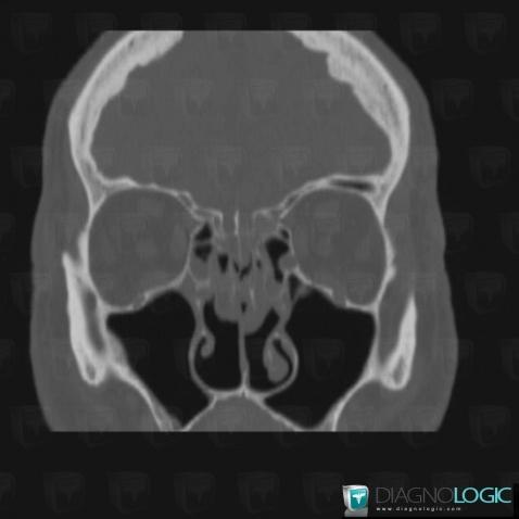 Sinusonasal polyposis, Nasal cavity / Nasopharynx, CT