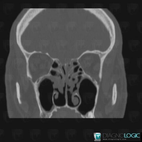 Sinusonasal polyposis, Sinus, CT