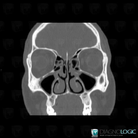 Sinusonasal polyposis, Sinus, CT