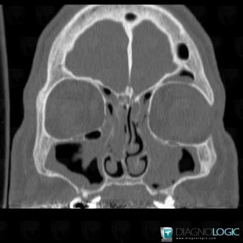 Sinusonasal polyposis, Sinus, CT