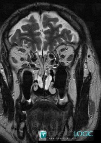 Sinusonasal polyposis, Sinus, MRI