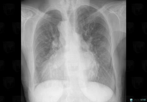 Situs inversus, Cardiac cavities / Pericardium, X rays
