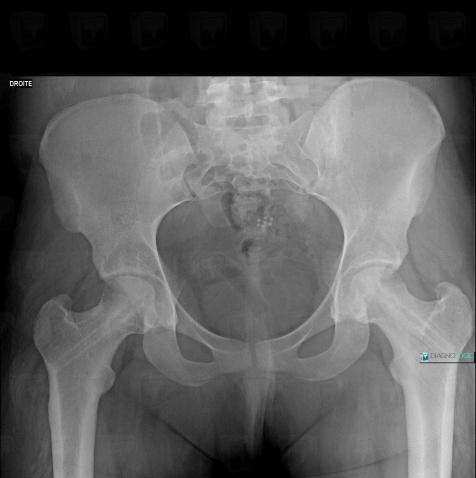 Slipped capital femoral epiphysis, Femur - Proximal part, X rays