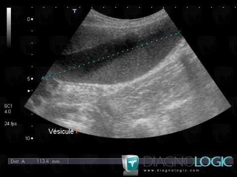 Sludge, Gallbladder, US