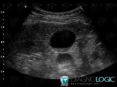 Sludge, Gallbladder, US