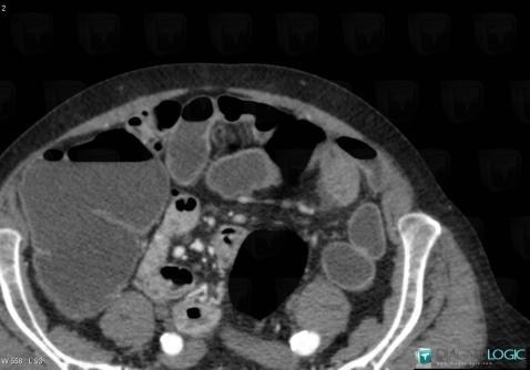 Small bowel adenocarcinoma, Small bowel, CT