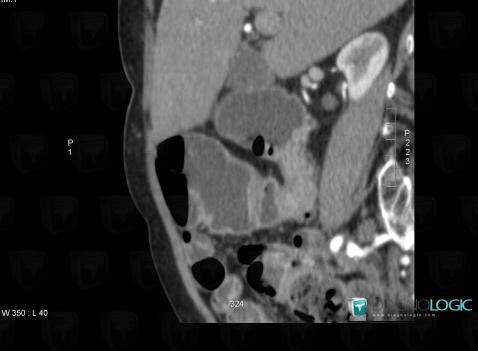 Small bowel adenocarcinoma, Small bowel, CT