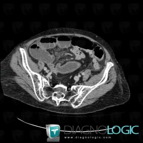 Small bowel adhesion, Small bowel, CT