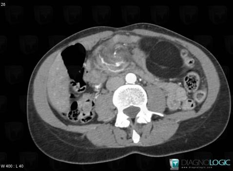 Small bowel volvulus, Small bowel, CT