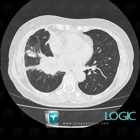 Small cell lung carcinoma, Pulmonary parenchyma, CT