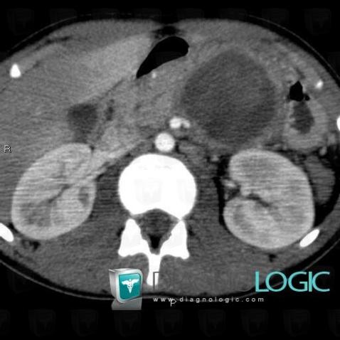 Solid and papillary neoplasm-pancreas, Pancreas, CT