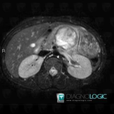 Solid and papillary neoplasm-pancreas, Pancreas, MRI