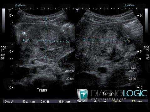 Solid and papillary neoplasm-pancreas, Pancreas, US