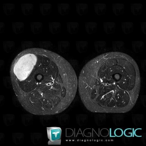 Solitary fibrous tumor, Muscles - Thigh, Other soft tissues/nerves - Thigh, MRI