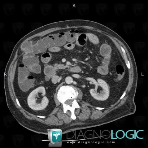 Spiegel hernia, Abdominal wall, CT