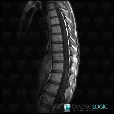 Spinal cord atrophy, Spinal canal / Cord, MRI