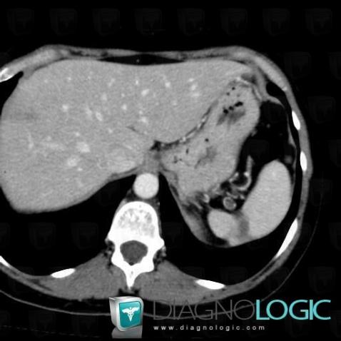 Splenic infarction, Spleen, CT