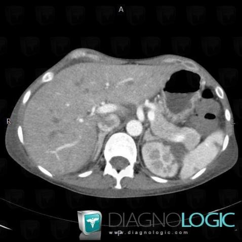 Splenic infarction, Spleen, CT