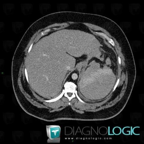 Splenic rupture , Spleen, CT