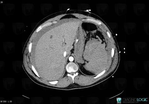 Splenic rupture , Spleen, CT