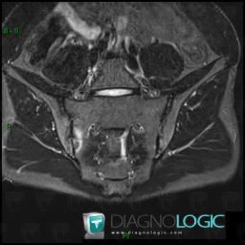 Spondylarthrite ankylosante, Articulation sacro iliaque, IRM