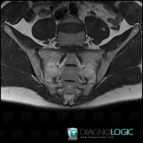Spondylarthrite ankylosante, Articulation sacro iliaque, IRM
