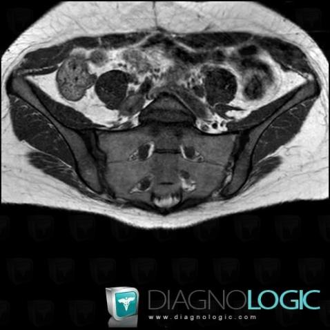 Spondylarthrite ankylosante, Articulation sacro iliaque, IRM