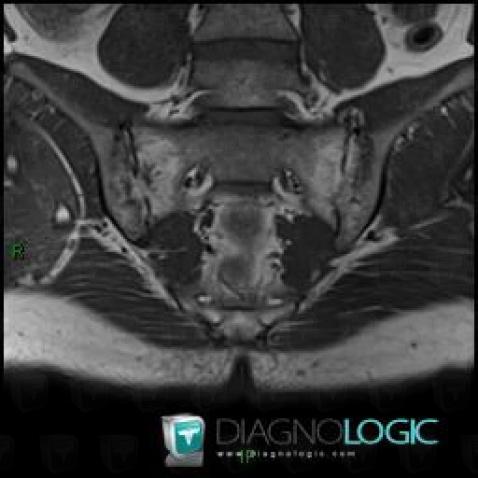 Spondylarthrite ankylosante, Articulation sacro iliaque, IRM