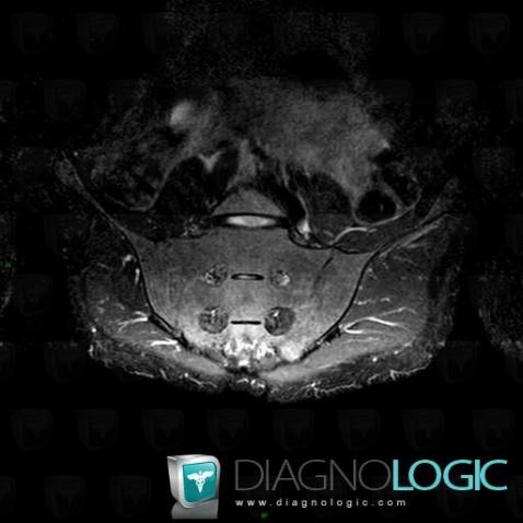 Spondylarthrite ankylosante, Articulation sacro iliaque, IRM