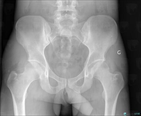 Spondylarthrite ankylosante, Articulation sacro iliaque, Radio