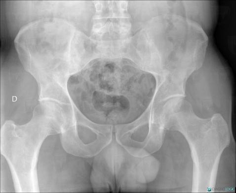 Spondylarthrite ankylosante, Articulation sacro iliaque, Radio