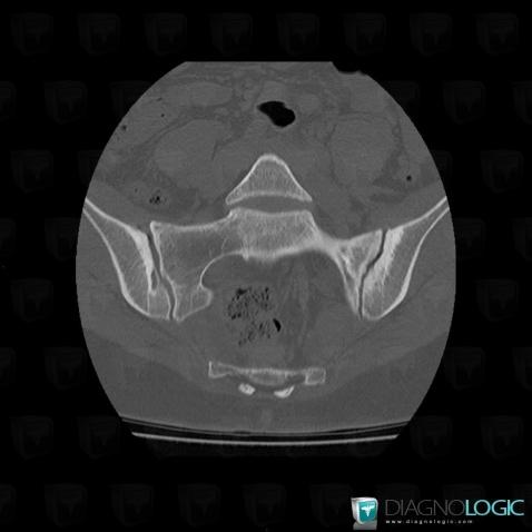 Spondylarthrite ankylosante, Articulation sacro iliaque, Scanner