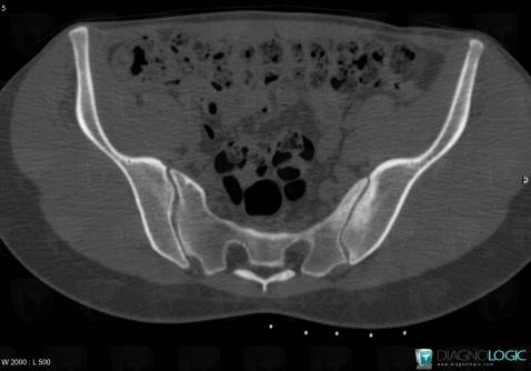 Spondylarthrite ankylosante, Articulation sacro iliaque, Scanner