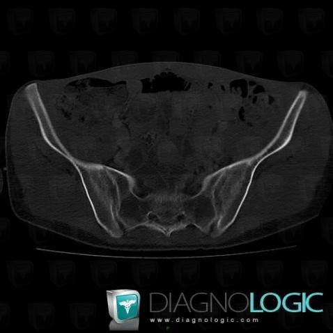 Spondylarthrite ankylosante, Articulation sacro iliaque, Scanner