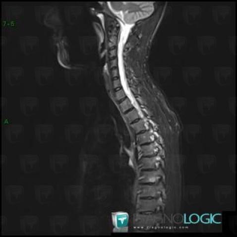 Spondylarthrite ankylosante, Corps vertébral / Disque, IRM