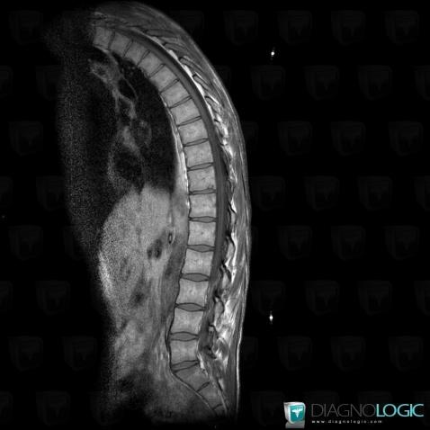 Spondylarthrite ankylosante, Corps vertébral / Disque, IRM