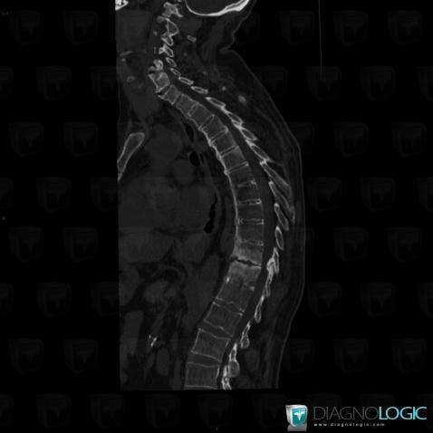 Spondylarthrite ankylosante, Corps vertébral / Disque, Scanner