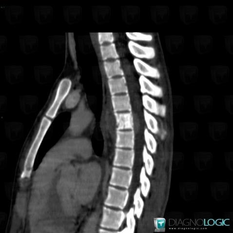 Spondylodiscite, Canal rachidien / Moelle, Scanner