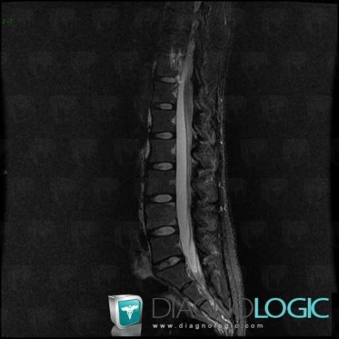 Spondylodiscite, Corps vertébral / Disque, IRM