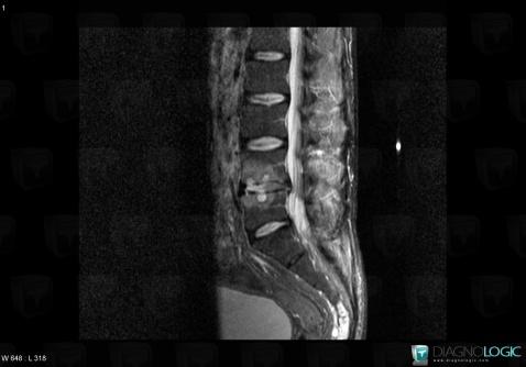 Spondylodiscite, Corps vertébral / Disque, IRM