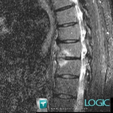 Spondylodiscite, Corps vertébral / Disque, IRM